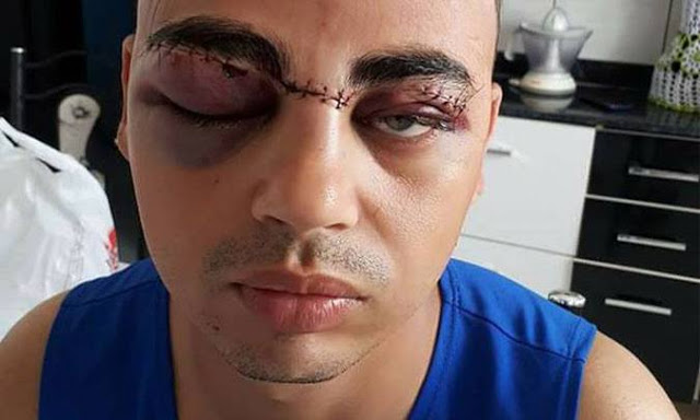 Motociclista tem rosto cortado por cerol e faz alerta na internet